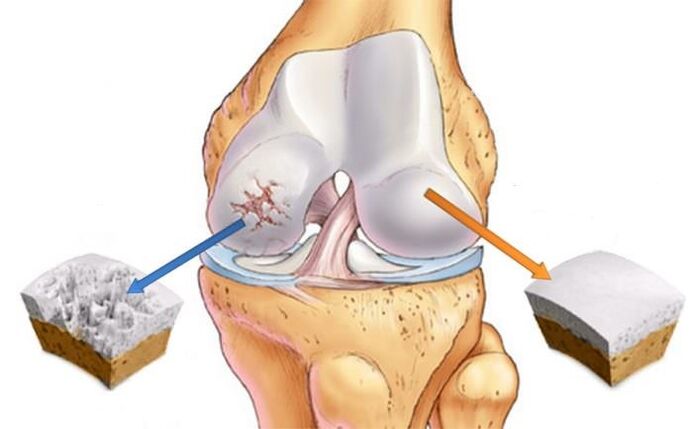 What is arthritis