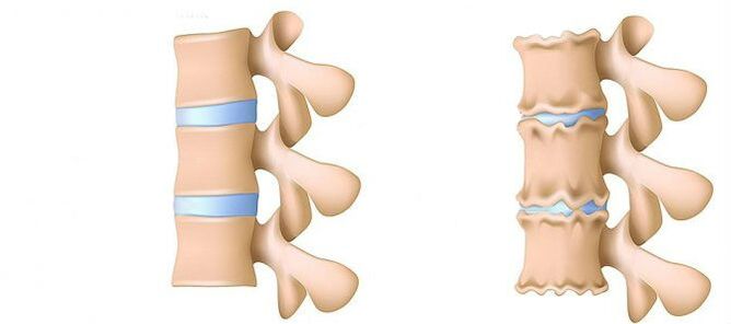 What is osteochondria