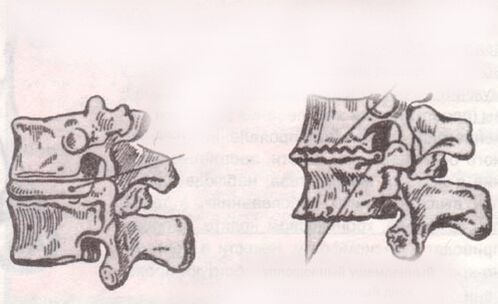 The intervertebral disk is healthy and with lumbar osteochondria