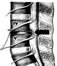 X -take the image of the lumbar part of osteochondry