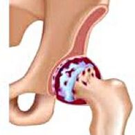 Articulation of hip joint