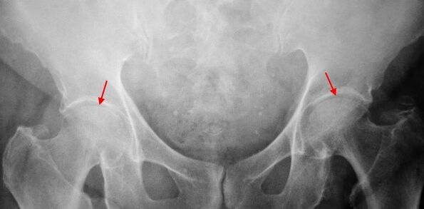 Double-view Coksartosis-Sustling of common vacuum, hardening of articular surfaces