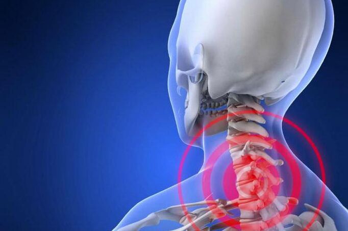 Neck pain is an early symptom of cervical osteochondrosis