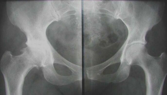 X-ray of the affected hip joint with arthropathy